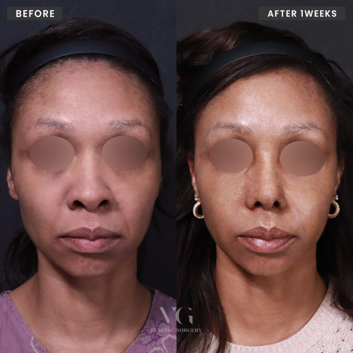 Resultados de alarplastia antes y después en VG Plastic Surgery, mejora de forma y simetría nasal