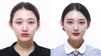 Before and after double eyelid surgery results at Клиника пластической хирургии INIQUÉ