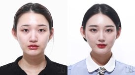 Before and after double eyelid surgery results at Клиника пластической хирургии INIQUÉ
