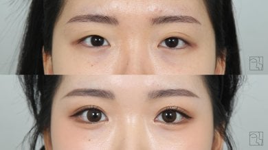 Before and after double eyelid surgery results at Клиника пластической хирургии INIQUÉ