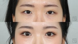 Before and after double eyelid surgery results at Клиника пластической хирургии INIQUÉ