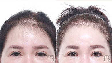 before-after photo podtazka-lba