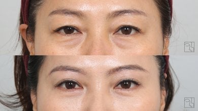 Before and after brow lift results at Клиника пластической хирургии INIQUÉ, rejuvenated eyes