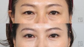 Before and after brow lift results at Клиника пластической хирургии INIQUÉ, rejuvenated eyes