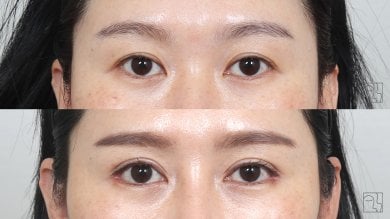Before and after brow lift results at Клиника пластической хирургии INIQUÉ, lifted eyebrows