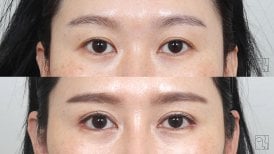 Before and after brow lift results at Клиника пластической хирургии INIQUÉ, lifted eyebrows