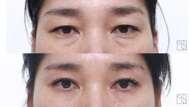 Before and after brow lift results at Клиника пластической хирургии INIQUÉ, rejuvenated eyes