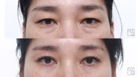 Before and after brow lift results at Клиника пластической хирургии INIQUÉ, rejuvenated eyes