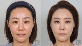 Before and after brow lift results at Клиника пластической хирургии INIQUÉ, youthful look