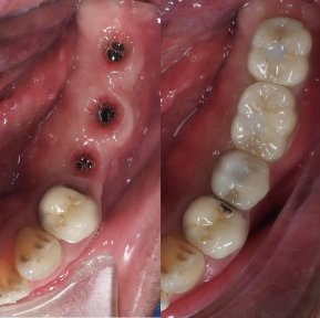 Vorher-nachher-Ergebnisse Zahnimplantat bei Dentist at home Clinic, Chonburi – restaurierte Molaren