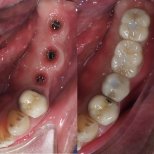 Vorher-nachher-Ergebnisse Zahnimplantat bei Dentist at home Clinic, Chonburi – restaurierte Molaren
