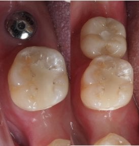 Résultat avant et après implant dentaire à Dentist at home Clinic, Chonburi – molaire restaurée
