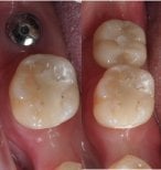 Résultat avant et après implant dentaire à Dentist at home Clinic, Chonburi – molaire restaurée