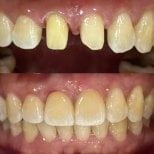 Résultats avant/après pose de couronnes dentaires chez Dentist at home, Bangkok, sourire amélioré