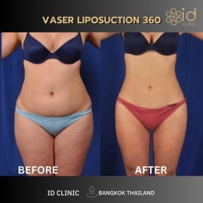 Результаты до и после VASER липосакции 360 в ID Clinic Bangkok, улучшенный контур тела