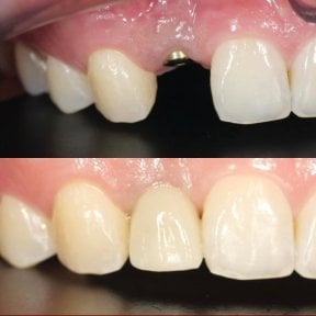 Before and after dental crown installation results at Dentist at home, Bangkok – improved smile