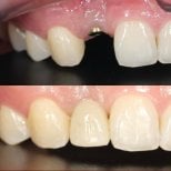 Before and after dental crown installation results at Dentist at home, Bangkok – improved smile