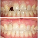Before and after dental crown installation at Dentist at home, Bangkok – restored front tooth result