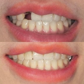Before and after dental crown installation at Dentist at home, Bangkok – restored smile result