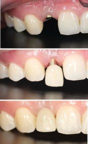 Dental implant before and after results at Dentist at home, Bangkok – restored front tooth