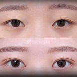 Résultats avant/après blépharoplastie supérieure chez VG Plastic Surgery, contour amélioré