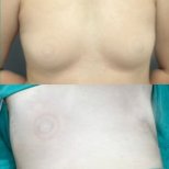 Efekty przed i po operacji ginekomastii w Munare Clinic Chiangmai, poprawiony kontur klatki