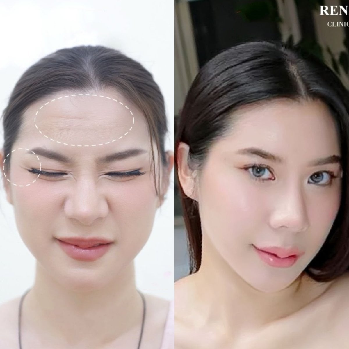 قبل وبعد حقن البوتوكس في REN Clinic – جبهة أكثر نعومة وتقليل التجاعيد