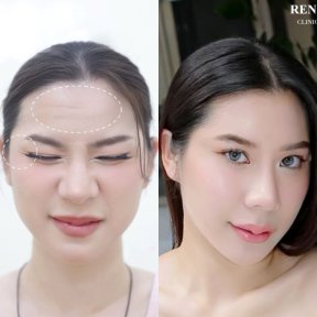 Vorher-nachher Botox-Injektionen bei REN Clinic – glattere Stirn, weniger Falten