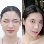 Vorher-nachher Botox-Injektionen bei REN Clinic – glattere Stirn, weniger Falten