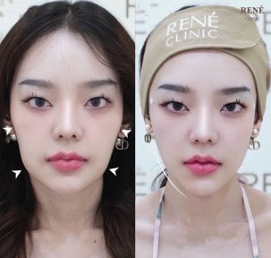 Before and after thread lifting results at René Clinic – facial contour enhancement