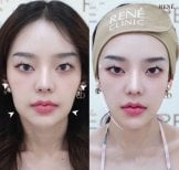 Before and after thread lifting results at René Clinic – facial contour enhancement