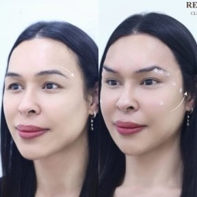 Resultados antes y después de lifting con hilos – elevación visible de cejas y contorno facial