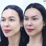 Resultados antes y después de lifting con hilos – elevación visible de cejas y contorno facial