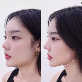 Resultados antes y después de lifting con hilos – mandíbula definida y rostro más firme