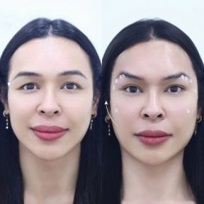 Resultados de lifting con hilos antes y después – elevación visible de cejas y frente lisa