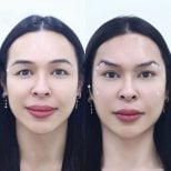 Resultados de lifting con hilos antes y después – elevación visible de cejas y frente lisa