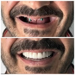 before-after photo implantaciya-zubov-po-tehnologii-all-on-4--vse-na-chetureh