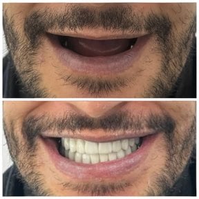 before-after photo implantaciya-zubov-po-tehnologii-all-on-4--vse-na-chetureh