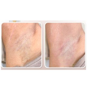 before-after photo laser-hair-removal