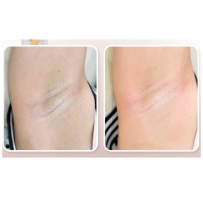 before-after photo laser-hair-removal