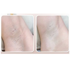 before-after photo laser-hair-removal