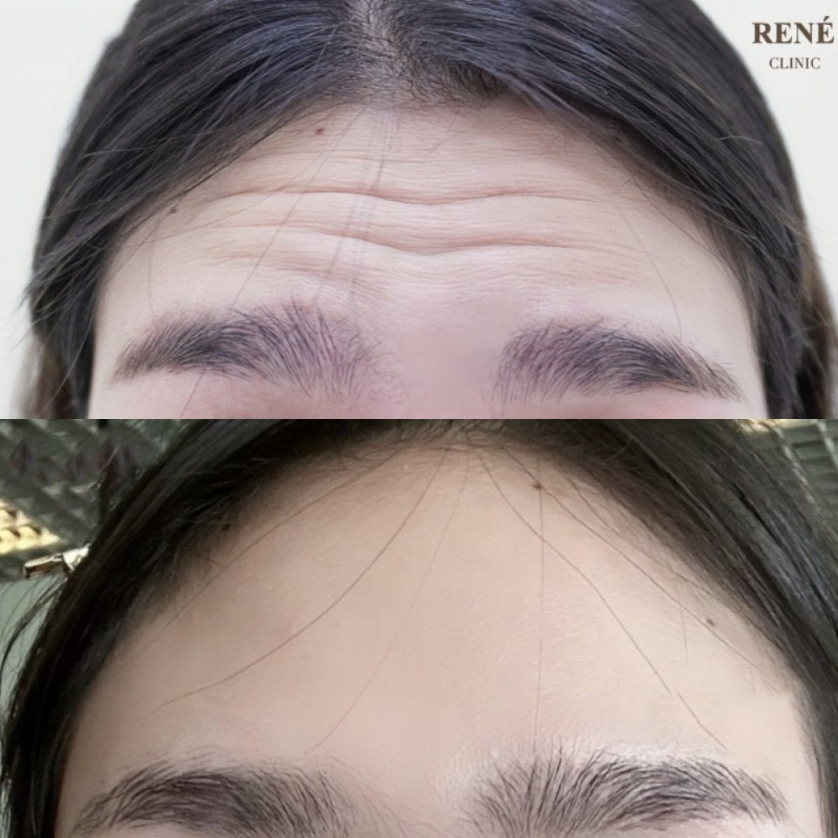 Antes y después de inyecciones de botox en RENÉ Clinic: frente más lisa