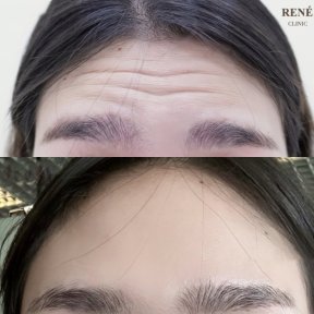 before-after photo botox-injections