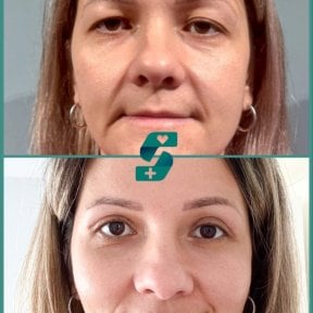 before-after photo upper-and-lower-eyelid-surgery
