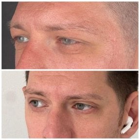 before-after photo upper-and-lower-eyelid-surgery