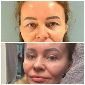 before-after photo upper-and-lower-eyelid-surgery