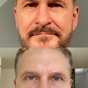 before-after photo upper-and-lower-eyelid-surgery