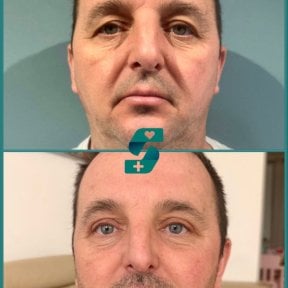 before-after photo upper-and-lower-eyelid-surgery