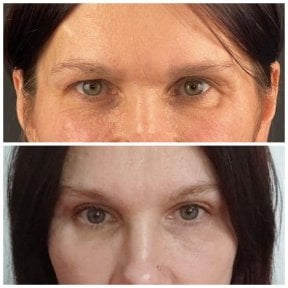 before-after photo upper-and-lower-eyelid-surgery
