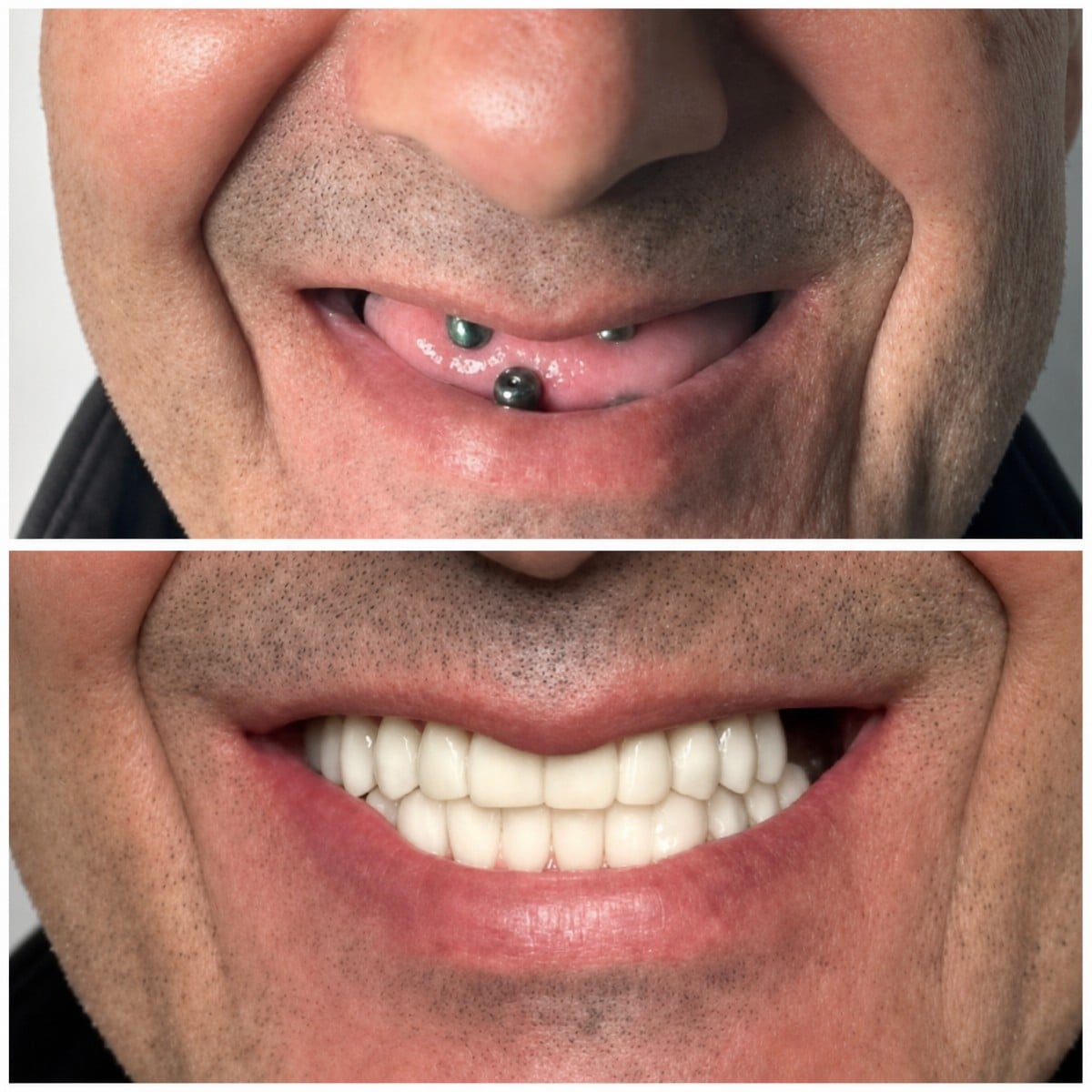 Resultados antes y después de implantes All-on-4 en Santa Caterina Clinic, sonrisa restaurada